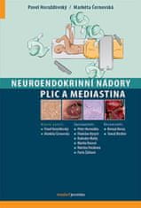 Pavel Horažďovský: Neuroendokrinní nádory plic a mediastina