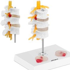 shumee 3D anatomický model driekovej chrbtice s herniovanými stavcami 3-5